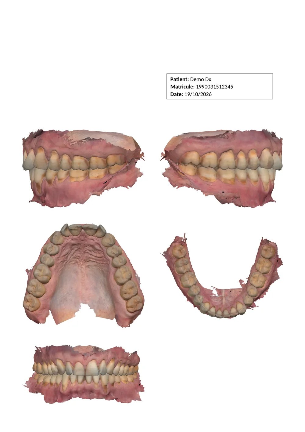 Rapport A4 exporté par Umbo pour un patient de démonstration : encadré patient et cinq vues du modèle 3D.
